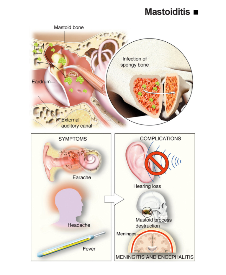 Infografis mastoiditis